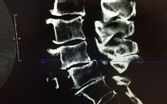 A Review of Conservative Options in the Treatment and Management of Lumbar Spinal Stenosis Blog Pic